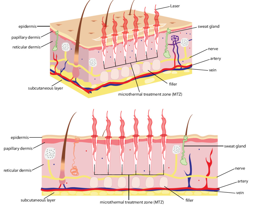 SKin_diagram how laser works on skin