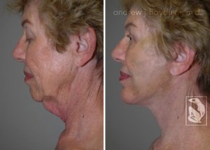 facelift-before-after-035