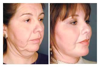 facelift-before-and-after-002