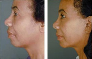 facelift-before-and-after-014