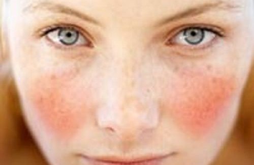 natural-cure-for-rosacea